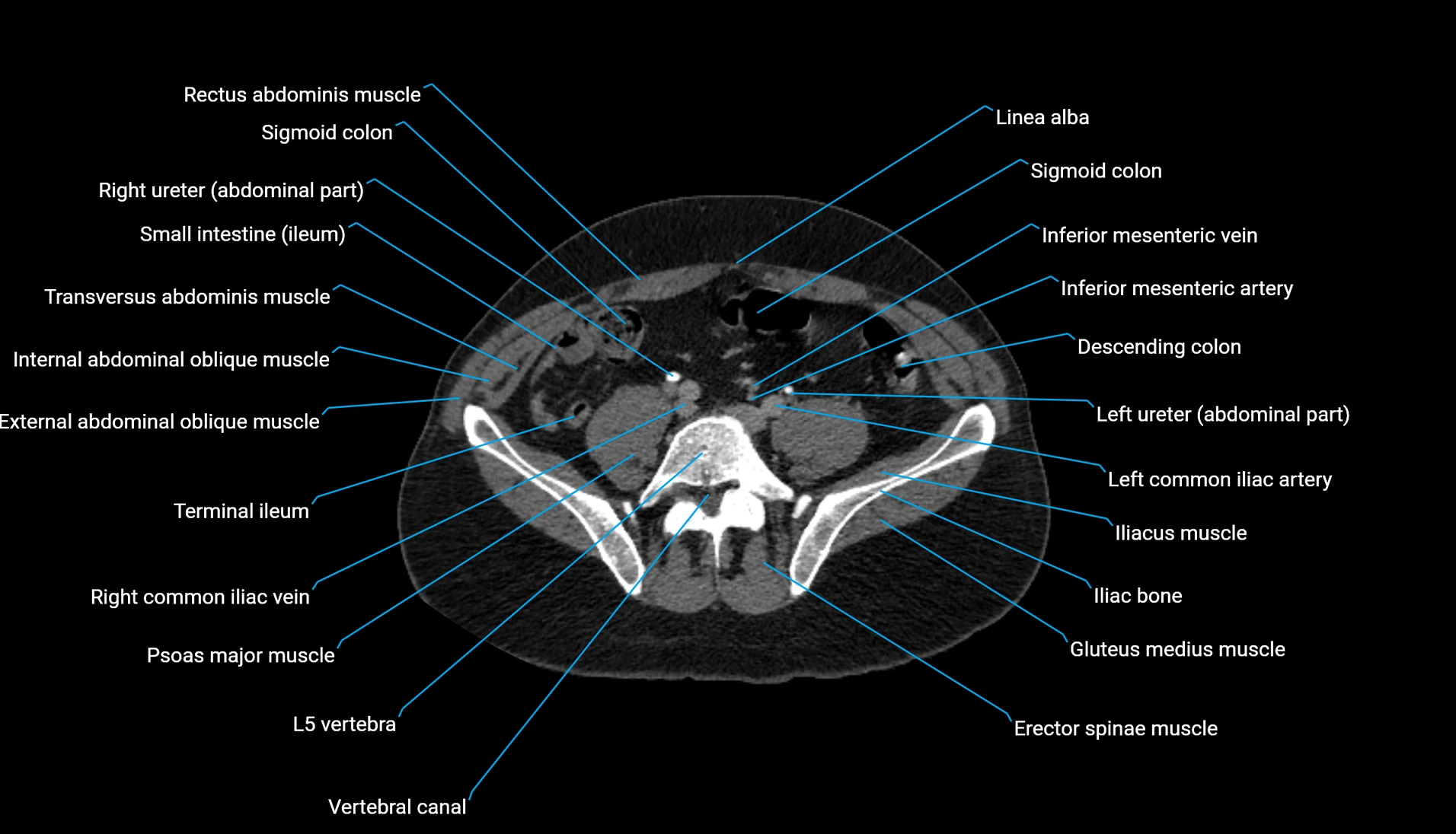 CT urogram axial cross sectional anatomy  labelled radiology image-00170.webp